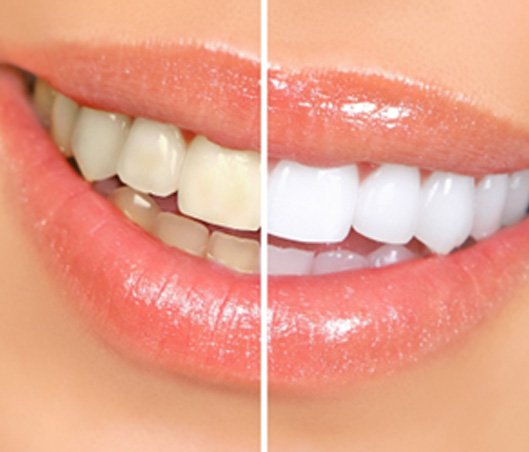 Closeup of woman's smile before and after teeth whitening