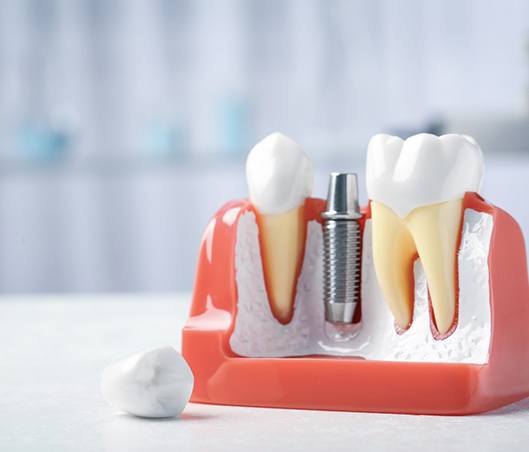 Model of dental implant in Fort Worth