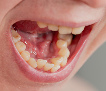 Patient in Fort Worth with crowded teeth
