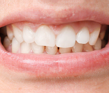 Patient in Fort Worth with bite alignment issue