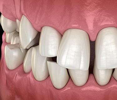 Illustration of gapped teeth