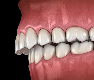 Illustration of an overbite