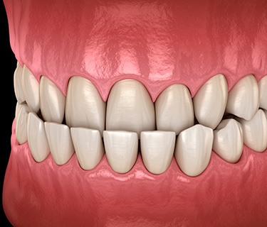Illustration of an underbite