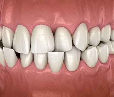 Illustration of a crossbite