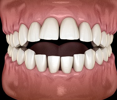 Illustration of an open bite