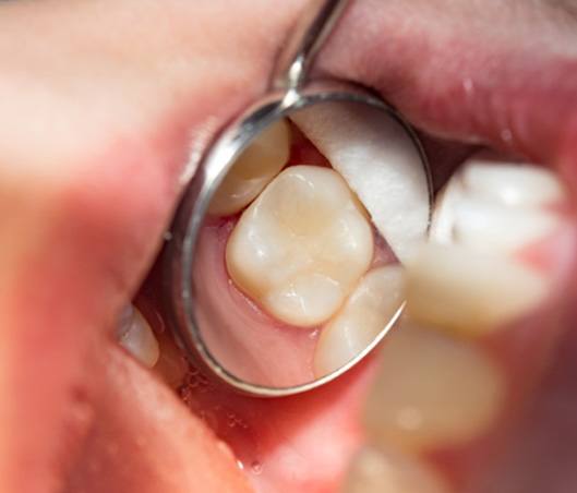 a dental mirror magnifying a tooth-colored filling