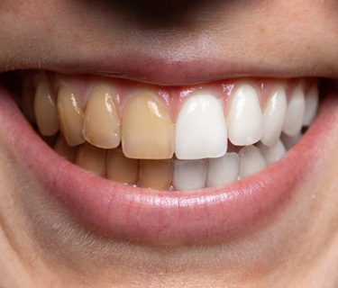 Up-close view of stained and brighter teeth 