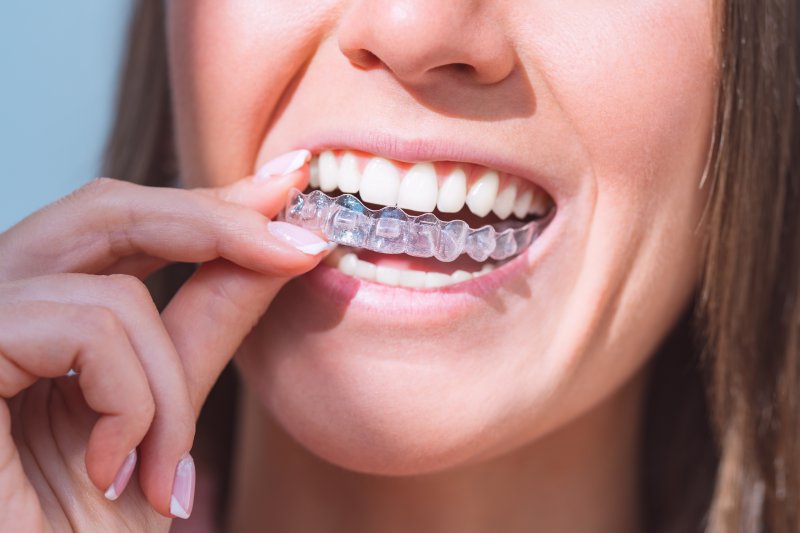 Woman taking clear aligners off her top row of teeth